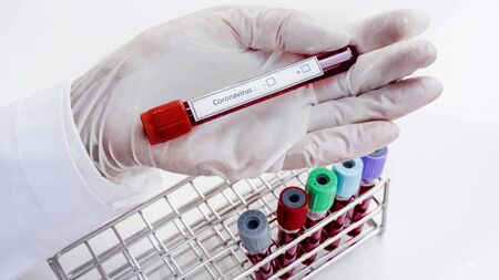 Hand of laboratory technician holding test tubes with blood, positive result of patients.の写真素材