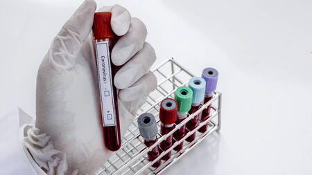 Hand of laboratory technician holding test tubes with blood, positive result of patients.の写真素材