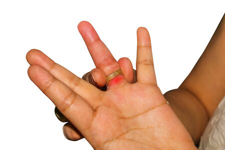 Remove the ring from the swollen handの写真素材