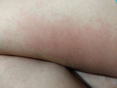 Red rash - skin reactions on the skin of women 's leg from cosmetics.