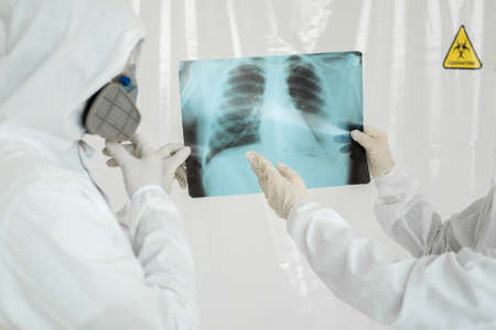 Doctors Epidemiologists examine x-ray for pneumonia of a Covid-19 patient. Coronavirus concept.の写真素材