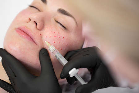 Close-up of cosmetologist makes the Rejuvenating facial injections procedure for tightening on the face skin of woman in a beauty clinic. Biorevitalization procedureの写真素材