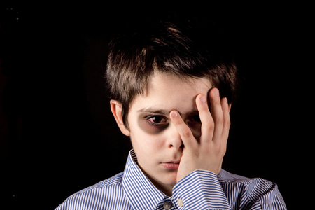little boy with black eye little boy with black eye