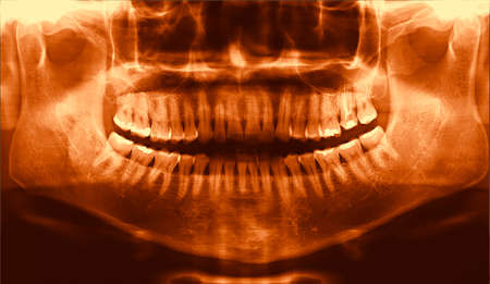 full arch wide maxillary male dental panoramic X-Ray radiographyの写真素材