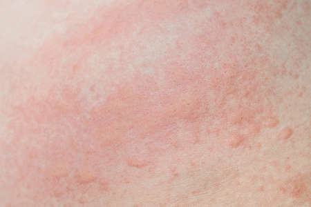 Allergic skin rash prickly heat skin red dot closeup skin problem itchingの写真素材