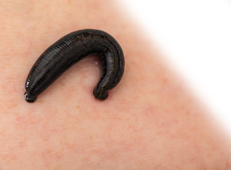hirudotherapy, medical leech the suction blood of