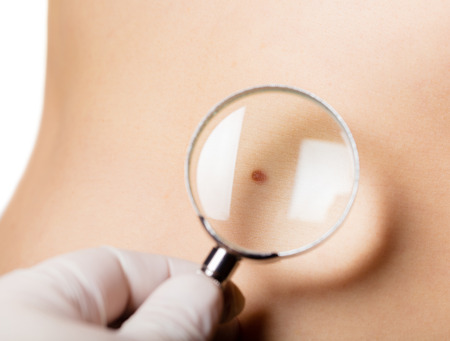 mole on body a person under the magnifying glassの写真素材