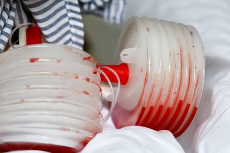 Jars for collecting lymph close-up. Postoperative drainage for outflow of lymph. A device for lymph after breast cancer surgery.の写真素材