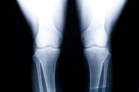 knee x-ray photo for backgroundの写真素材