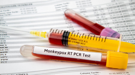 Blood tests for monkeypox virus, yellow syringe and blood test tubes on the paper of test results, selective focus, noise effectの写真素材