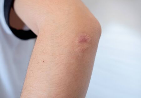 close-up scar on a woman's elbow on a white backgroundの写真素材