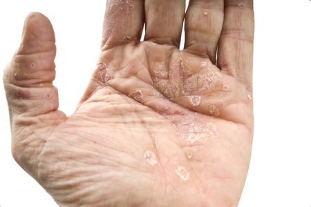 Psoriasis, skin disease on the joints of the bodyの写真素材