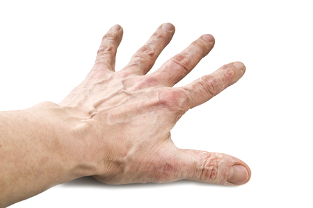 Psoriasis, skin disease on the joints of the bodyの写真素材