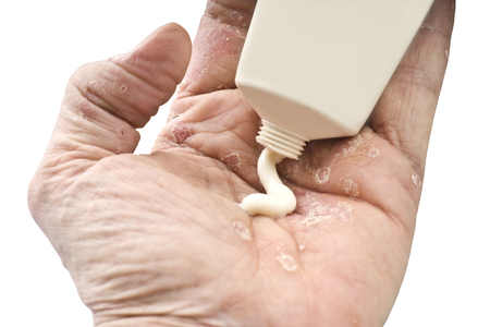Psoriasis, skin disease on the joints of the bodyの写真素材