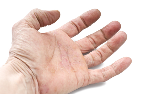 Psoriasis, skin disease on the joints of the bodyの写真素材