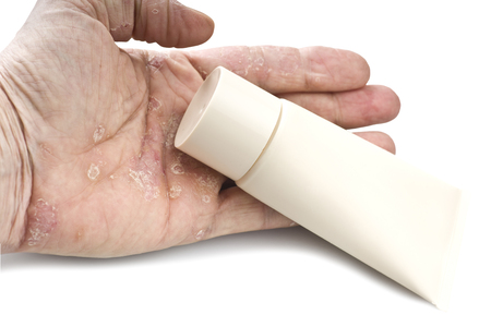 Psoriasis, skin disease on the joints of the bodyの写真素材