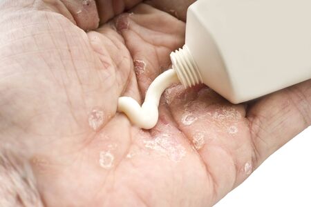 Psoriasis, skin disease on the joints of the bodyの写真素材