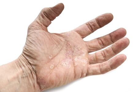 Psoriasis, skin disease on the joints of the bodyの写真素材