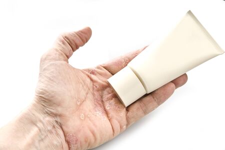 Psoriasis, skin disease on the joints of the bodyの写真素材