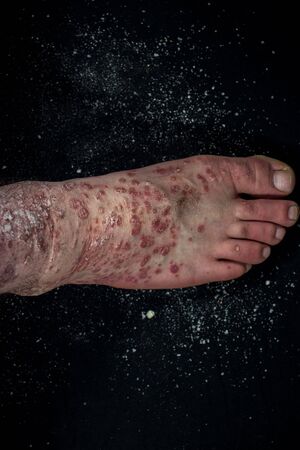Psoriasis (eczema) on the foot Man itching skin Psoriasis scales are scattered on black background