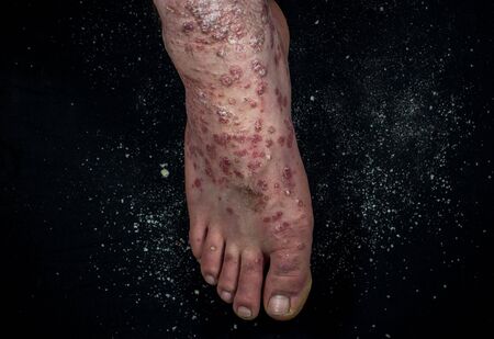 Psoriasis (eczema) on the foot Man itching skin Psoriasis scales are scattered on black background