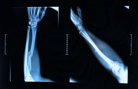 x-ray image show fracture of the radius boneの写真素材
