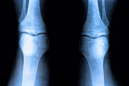 X-Ray image of the human knee