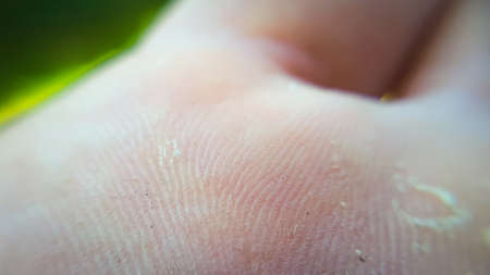 Macro human unhealthy skin. Dermatology surface. Caucasian skin with deasise. Closeup hand skin...