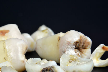 A collection of infected teeth with karies pictured on black