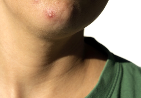 Acne problem on a part of a head, with isolated background.の写真素材