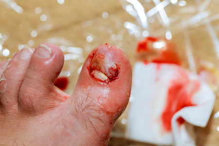 Bruise on toe nail on right foot man Torn nail blood on the legの写真素材