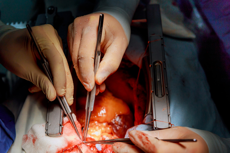 Soft natural background. Surgeon during an operation on the open heart