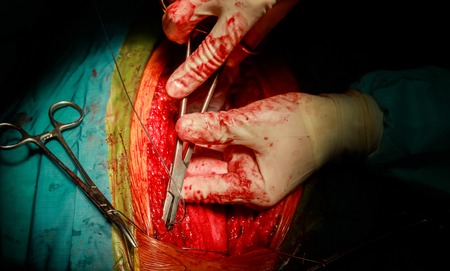 Stitching tissue after cardiac surgery stitched up skin after an operation