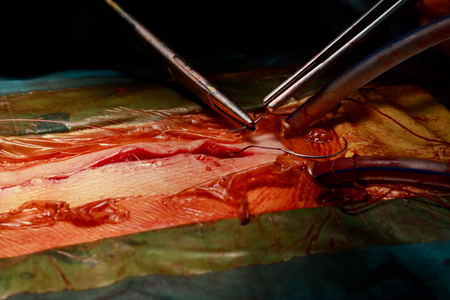 A surgeon is stitching a wound after an closeup operation in a hospital
