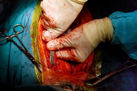 Surgeon hands the open heart surgery procedureの写真素材