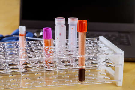 Medical equipment blood sample tube from a rack with analysis in the lab test in the research...