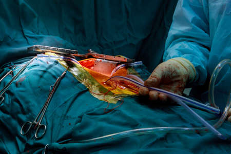 Teamwork surgeons during open heart surgery doctor holding surgical instruments during medical procedure at clinicの写真素材
