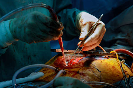 During surgery doctor close up hands of open heart of surgeons