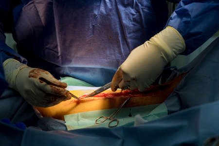 Operating during surgery with cutting legs for internal intervention in open woundsの写真素材