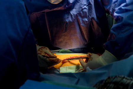 Operating room cutting legs for internal intervention during surgery