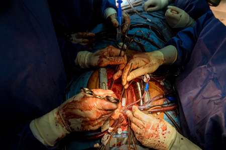 Opened chest during the surgery with coronary artery bypass grafting on open human heart close-up
