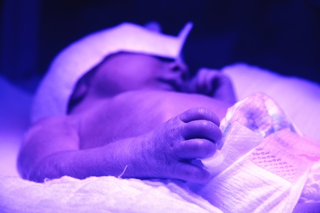 Treatment of a baby with neonatal jaundice in a hospital