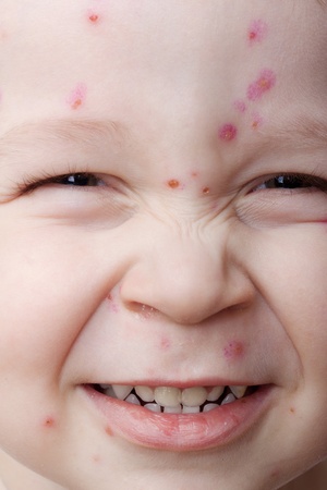 Portrait of a smiling child ailing chickenpox