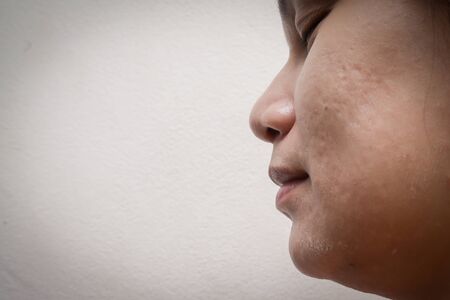 Female faces are rashes and acne scars.