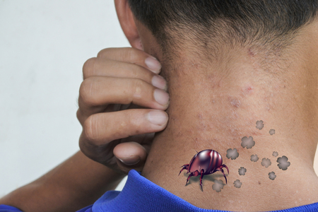 Picture dust mites, skin rashes from dust mite