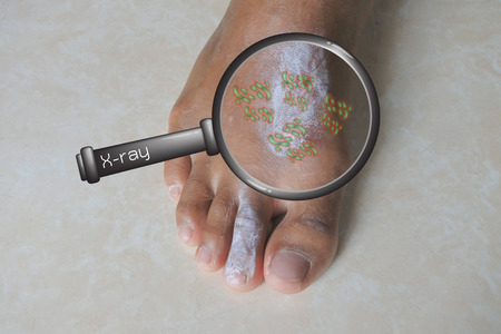 Zoom magnifying glass With infected skin