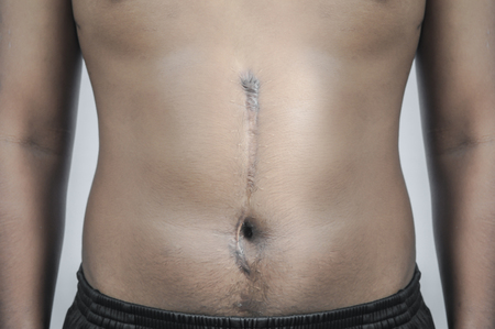 large scar after surgery on abdomen, photo on white backgroundの写真素材