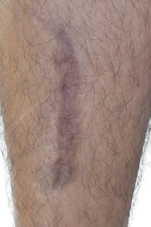large scar after accident, photo on the white background.の写真素材