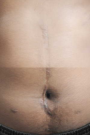 Comparision of skin after scar removal procedure,の写真素材
