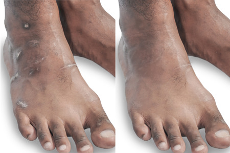 Compare foot scars from diabetes after post-scar removal.の写真素材